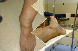 Paciente com perna fraturada e ligamento rompido foi diagnosticado apenas com uma torção no tornozelo.