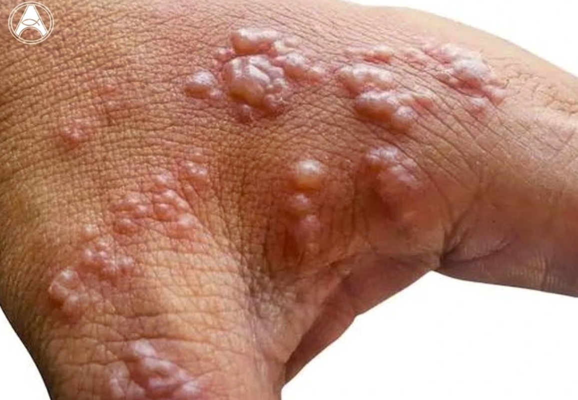 variola sintoma